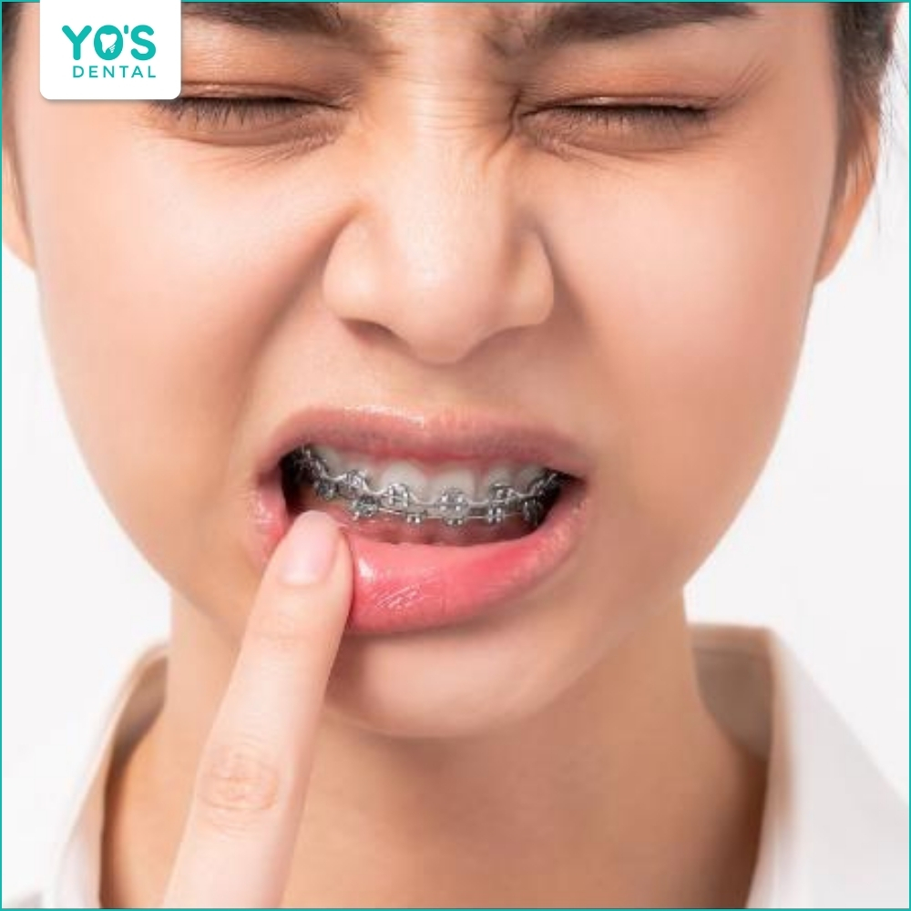 Niềng răng thời gian đầu có thể gây vướng víu, khó chịu