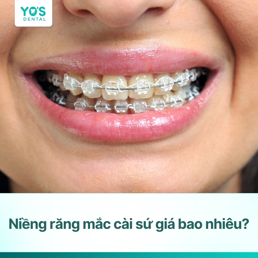 Niềng răng mắc cài sứ giá bao nhiêu? Cập nhật chi phí mới nhất