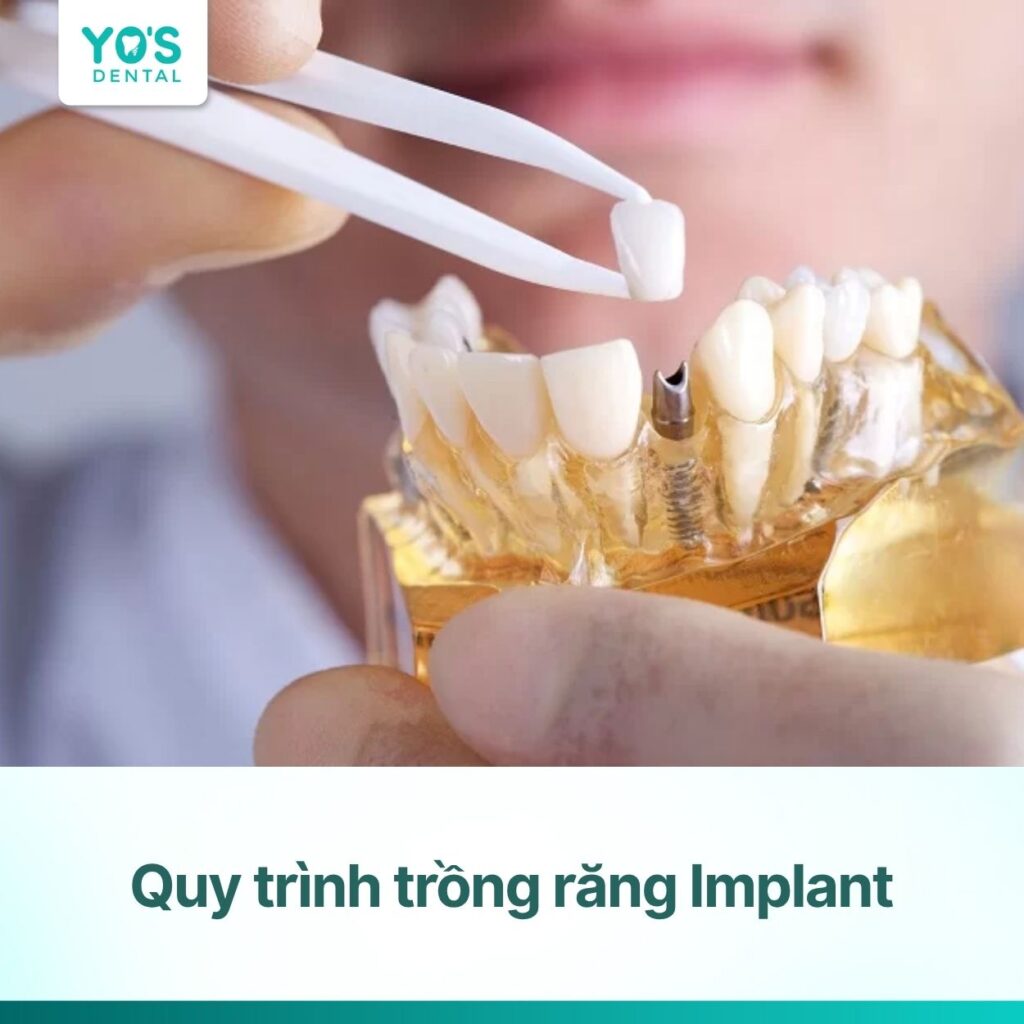 Quy trình trồng răng Implant 6 bước an toàn, chuẩn Y khoa