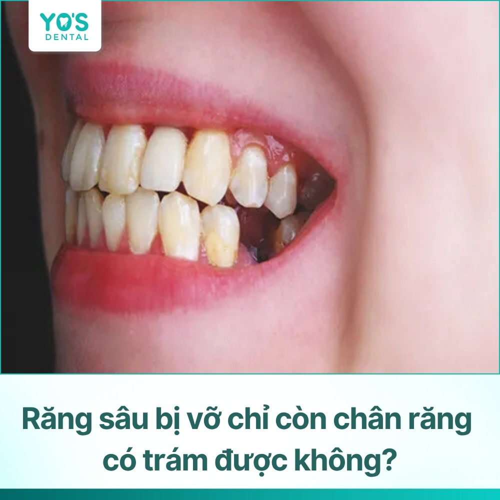 Răng sâu bị vỡ chỉ còn chân răng có trám được không? Điều trị thế nào?