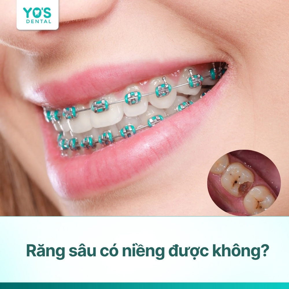 Răng sâu có niềng được không? Giải đáp từ chuyên gia