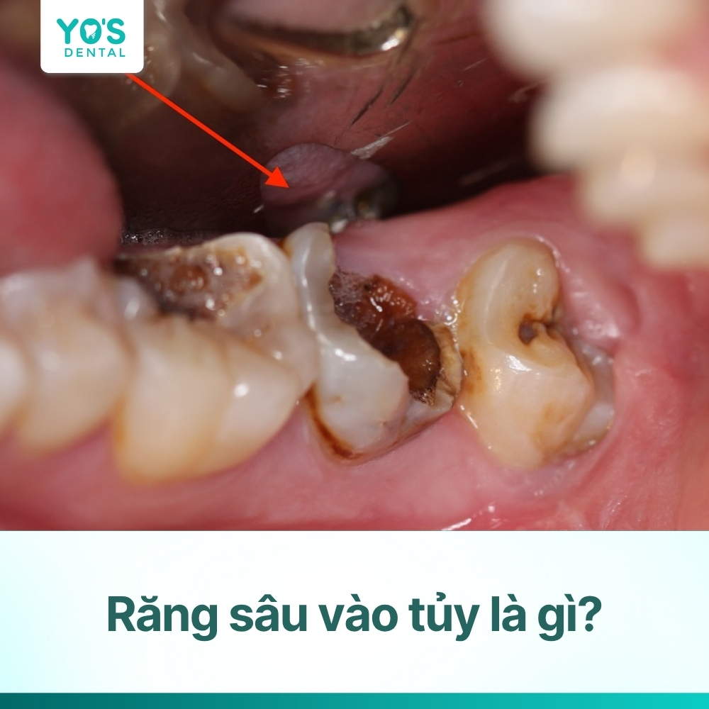 Răng sâu vào tủy: Dấu hiệu nhận biết và cách điều trị hiệu quả