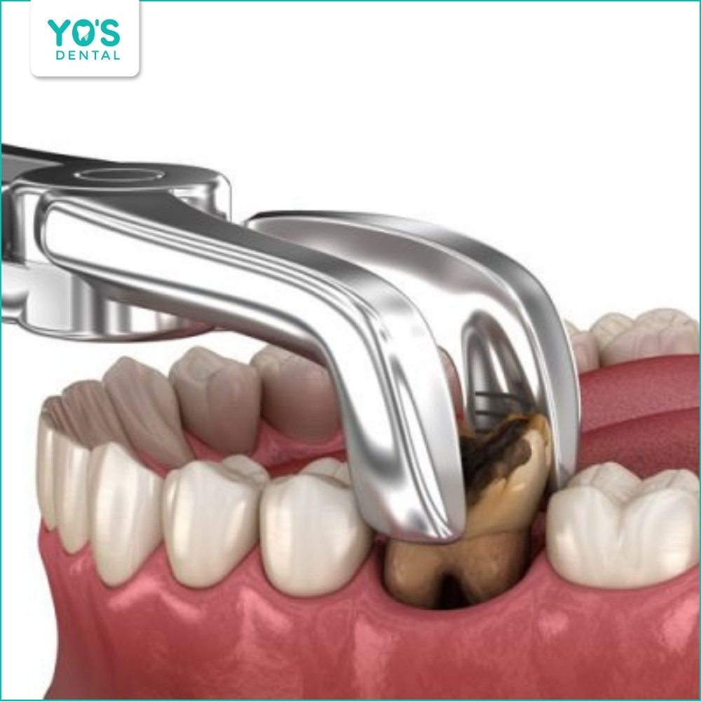 Nhổ răng khi răng sâu vào tủy quá nặng