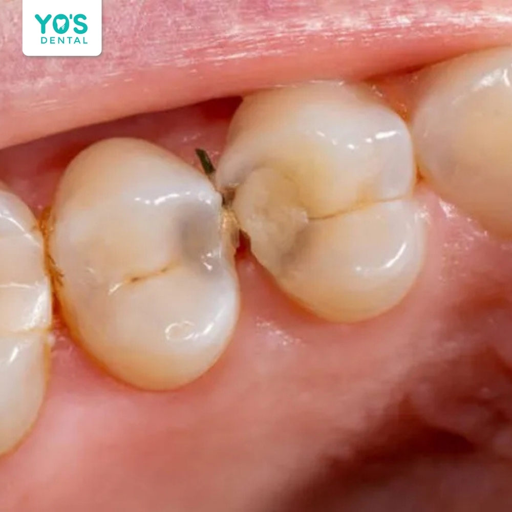 Sâu kẽ răng hàm thường xuất hiện ở vùng tiếp giáp giữa các răng cối
