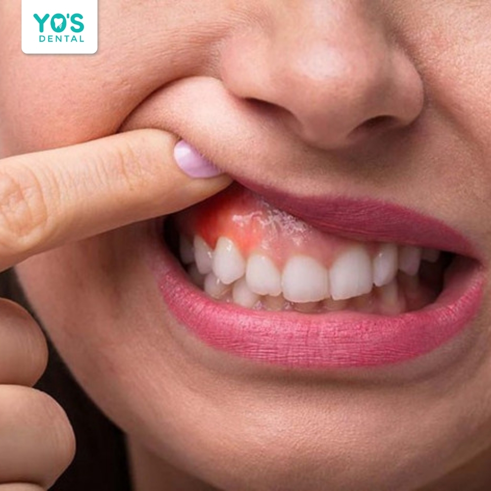 Sâu kẽ răng nếu không được điều trị kịp thời có thể tiến triển thành viêm tủy