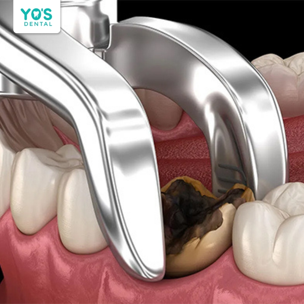 Nhổ răng khi răng sâu không còn biện pháp bảo tồn