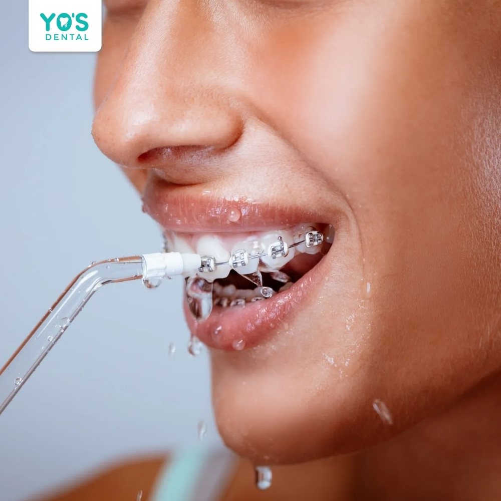 Vệ sinh răng miệng kỹ lưỡng giúp ngăn ngừa viêm nướu và tụt lợi