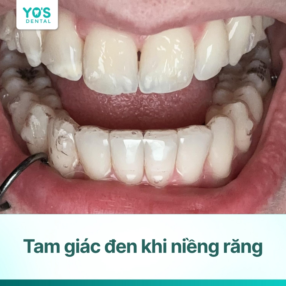 Tam giác đen khi niềng răng: Nguyên nhân & cách khắc phục