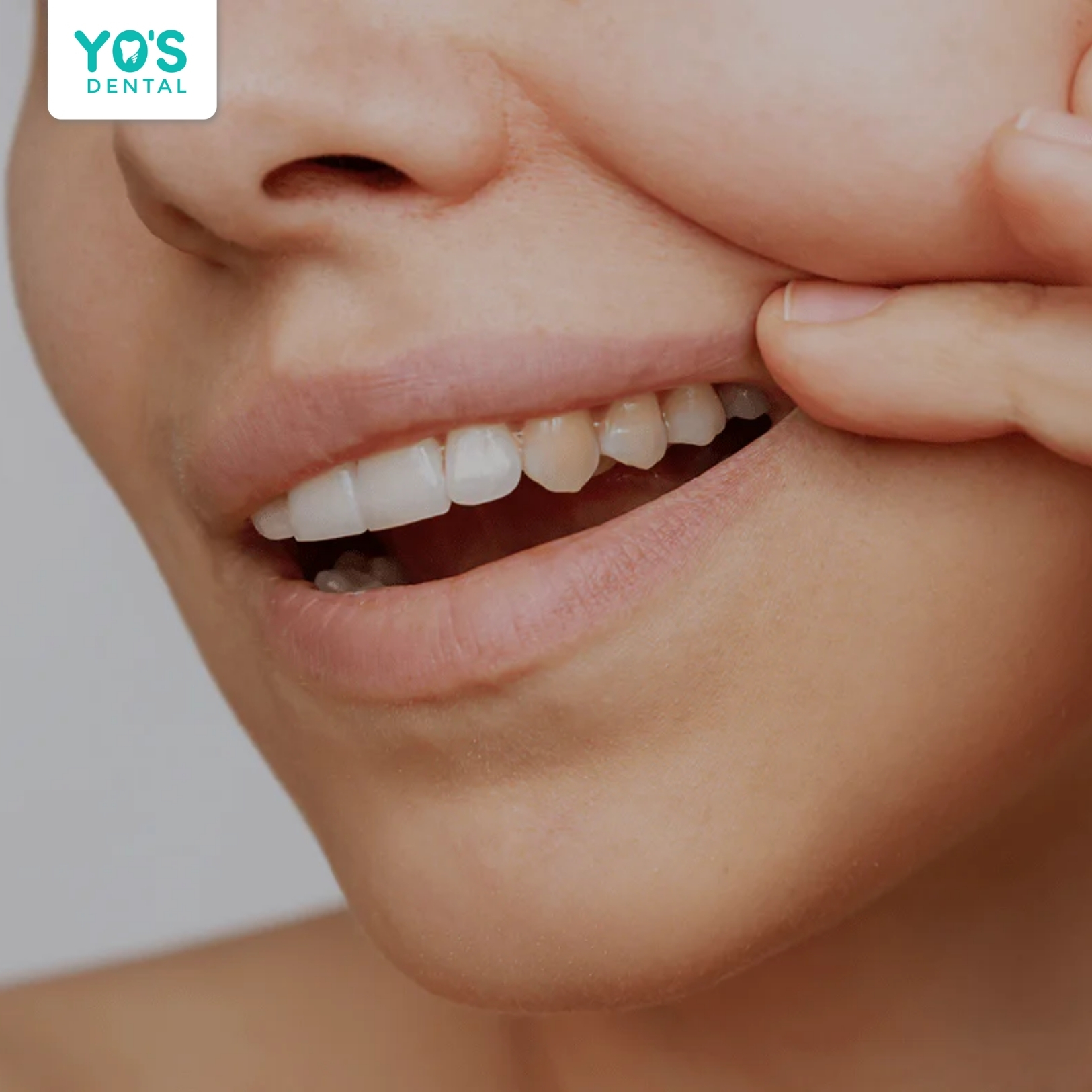 Lạm dụng tẩy trắng tại nhà có thể khiến màu răng loang lổ không đều