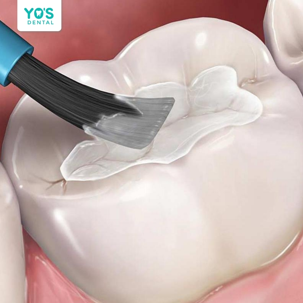 Sâu răng có thể tái phát nếu không chăm sóc răng miệng đúng cách