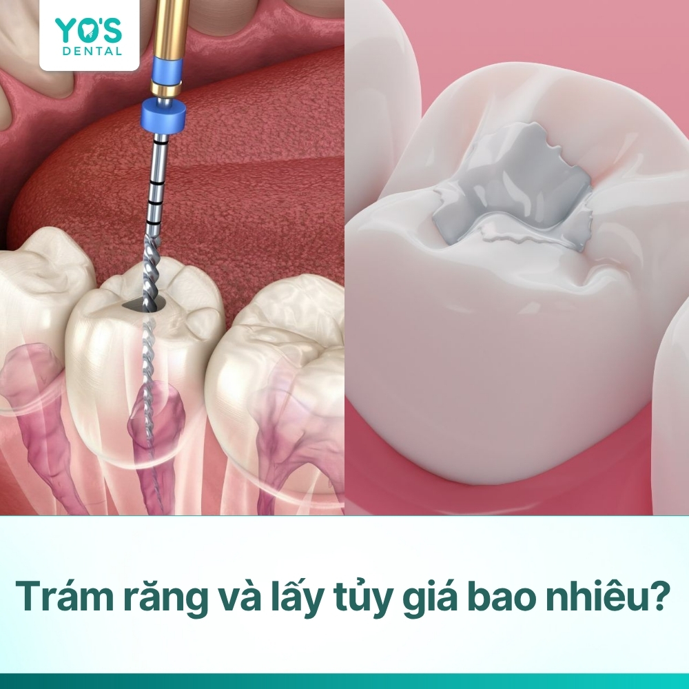 Trám răng và lấy tủy giá bao nhiêu? Quy trình chuẩn an toàn