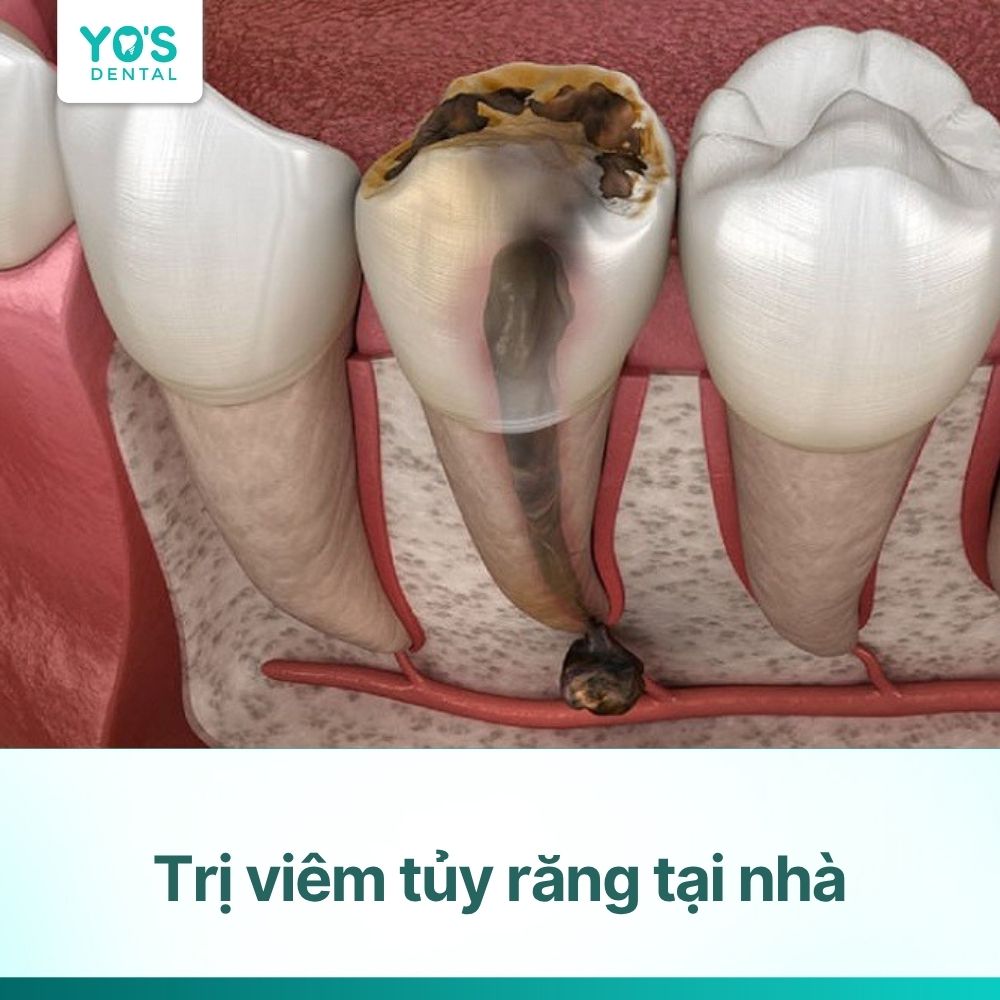 Trị viêm tủy răng tại nhà: Khi nào nên đến nha khoa?