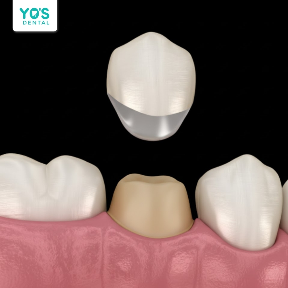 Bọc sứ giúp tăng độ bền và kéo dài tuổi thọ răng đã lấy tủy.