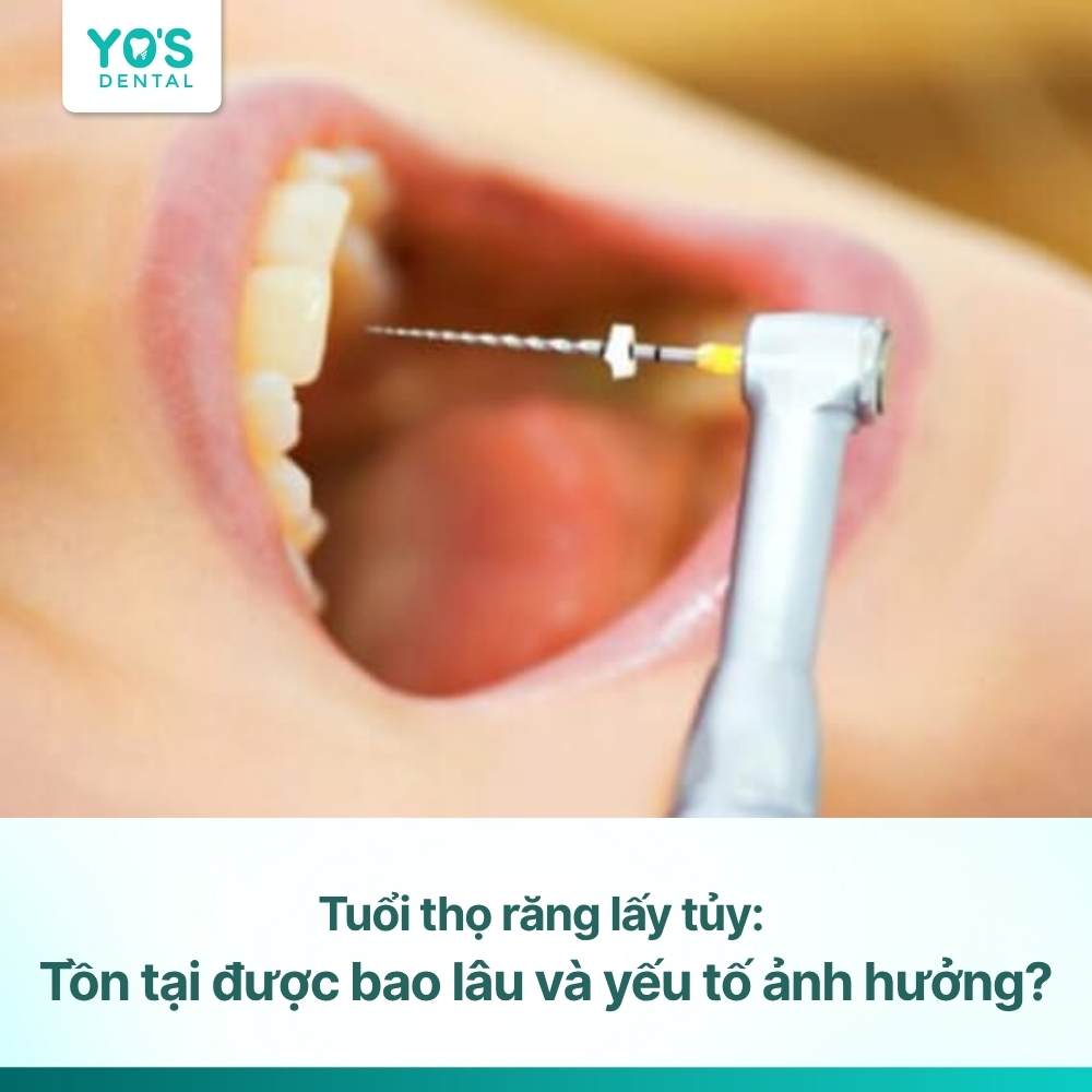Tuổi thọ răng lấy tủy: Tồn tại được bao lâu và yếu tố ảnh hưởng?