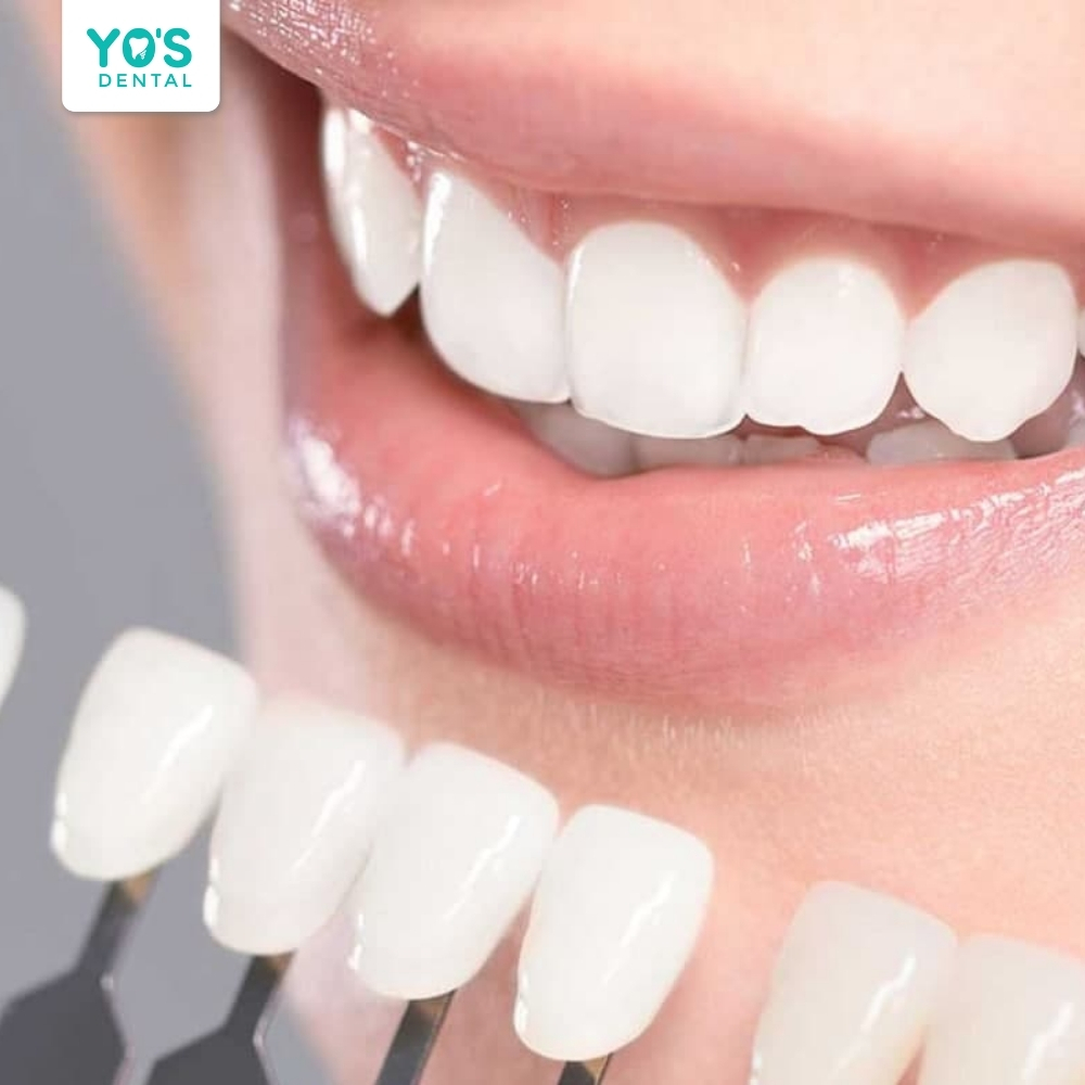 Tẩy trắng răng là phương pháp nha khoa giúp cải thiện màu sắc răng