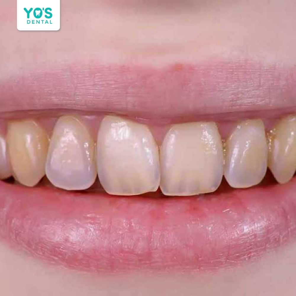 Men răng mỏng hoặc bệnh lý răng miệng là nguyên nhân gây ê buốt
