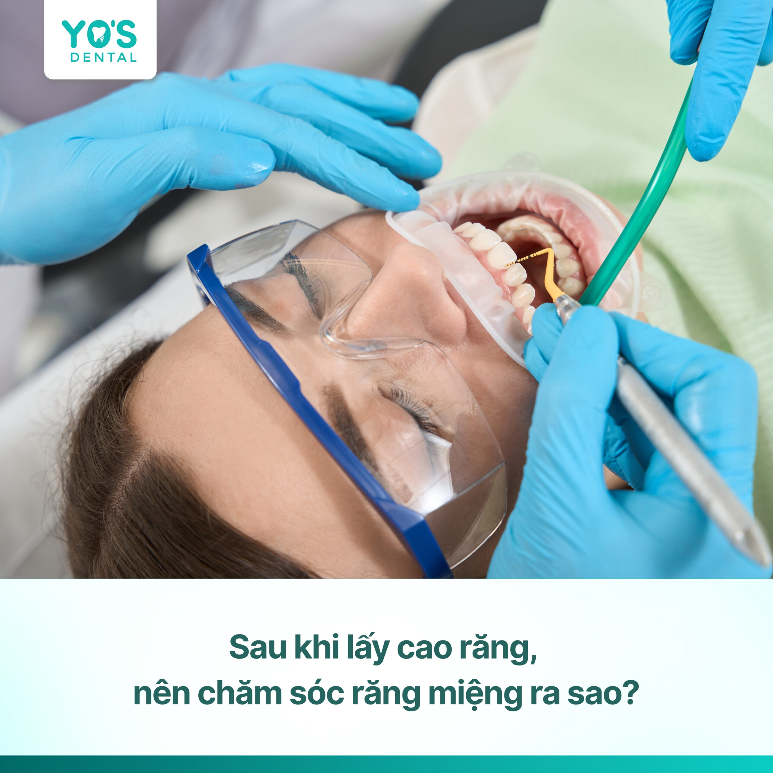Lấy cao răng xong kiêng gì để răng chắc khỏe tại Nha khoa Yo's Dental?
