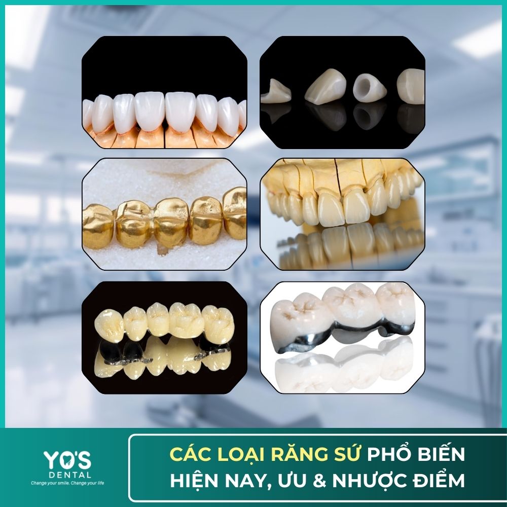 các loại răng sứ