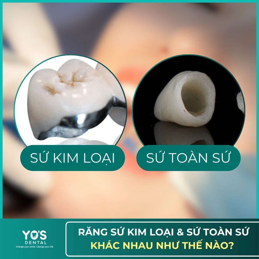 sự khác nhau của sứ kim loại và toàn sứ
