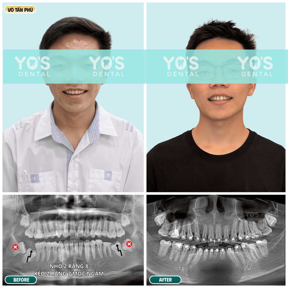 [NRKL] VÕ TẤN PHÚ