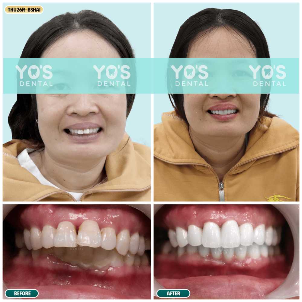 [RTS] Thu PH26R Cercon-Bs Hải (SG10)