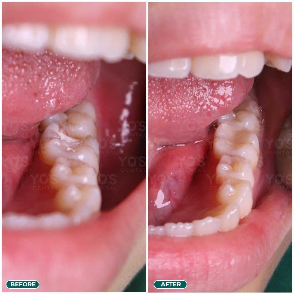 [TR] Trần Thị Quỳnh Trang #16951 R36 Trám sau điều trị tủy-MLinh